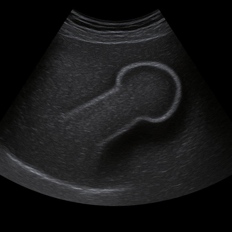 Ultrasound Penis