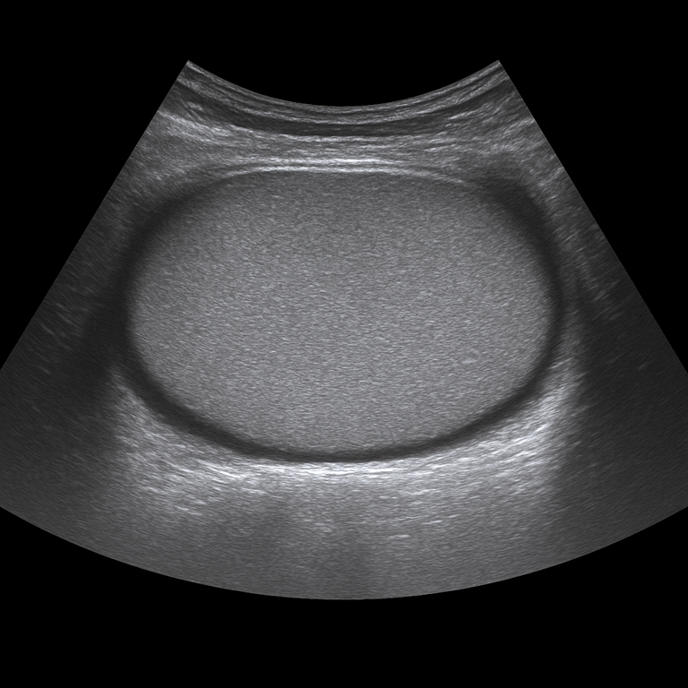 Ultrasound Testicles