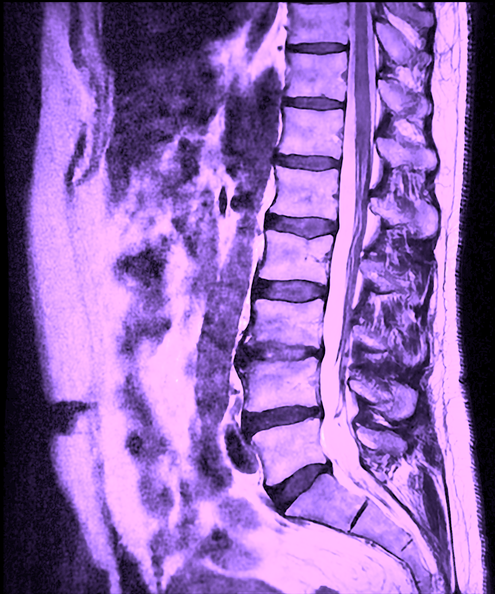 What does an MRI of the lumbar spine show?