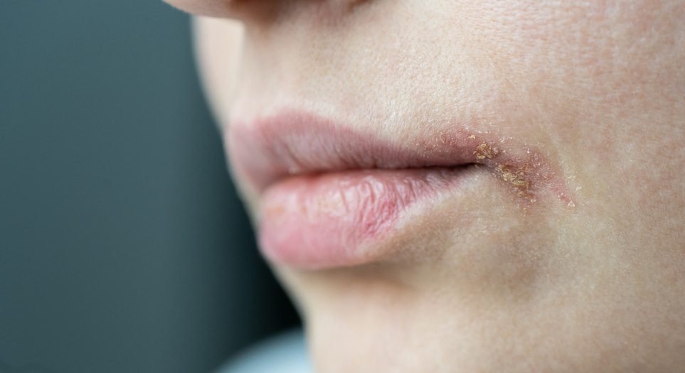 Cold sores – how to know if it's herpes