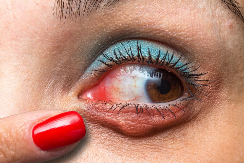 Eye Infection – When Does It Go Away on Its Own?