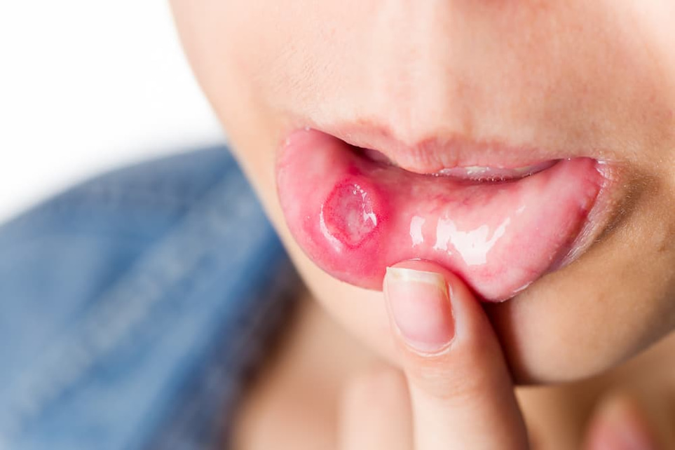 What is aphthous ulcers? Everything you need to know about mouth sores