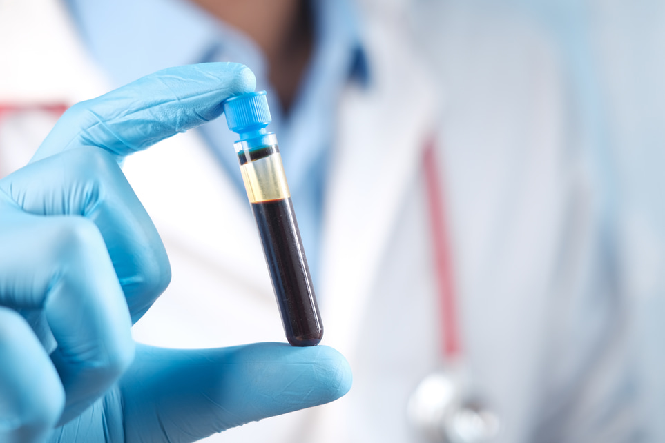 Analys av blodprov - Serum eller plasma detta är skillnaden