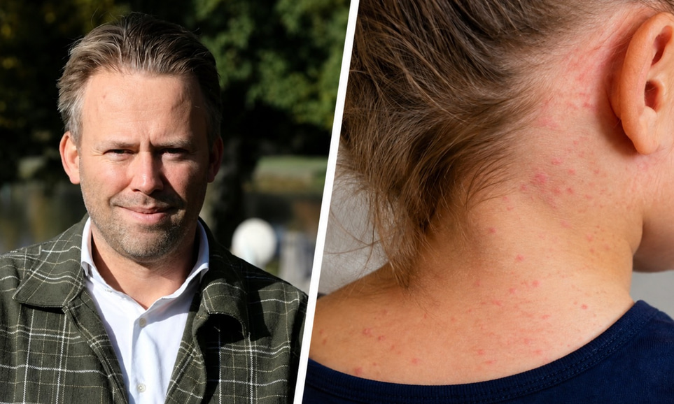 Mässling i Sverige 2026 – symtom, utslag och kan man bli smittad trots vaccin?